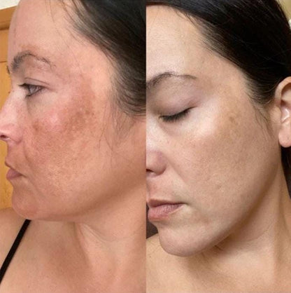 Hyperpigmentation Bundle