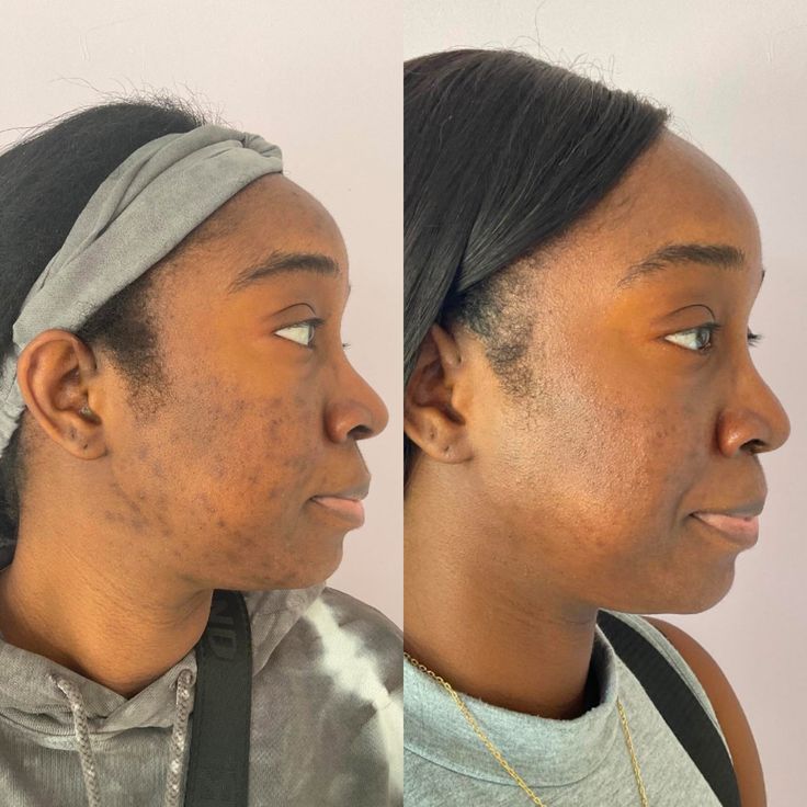Hyperpigmentation Bundle