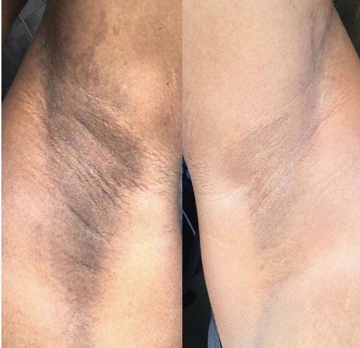 Hyperpigmentation Bundle